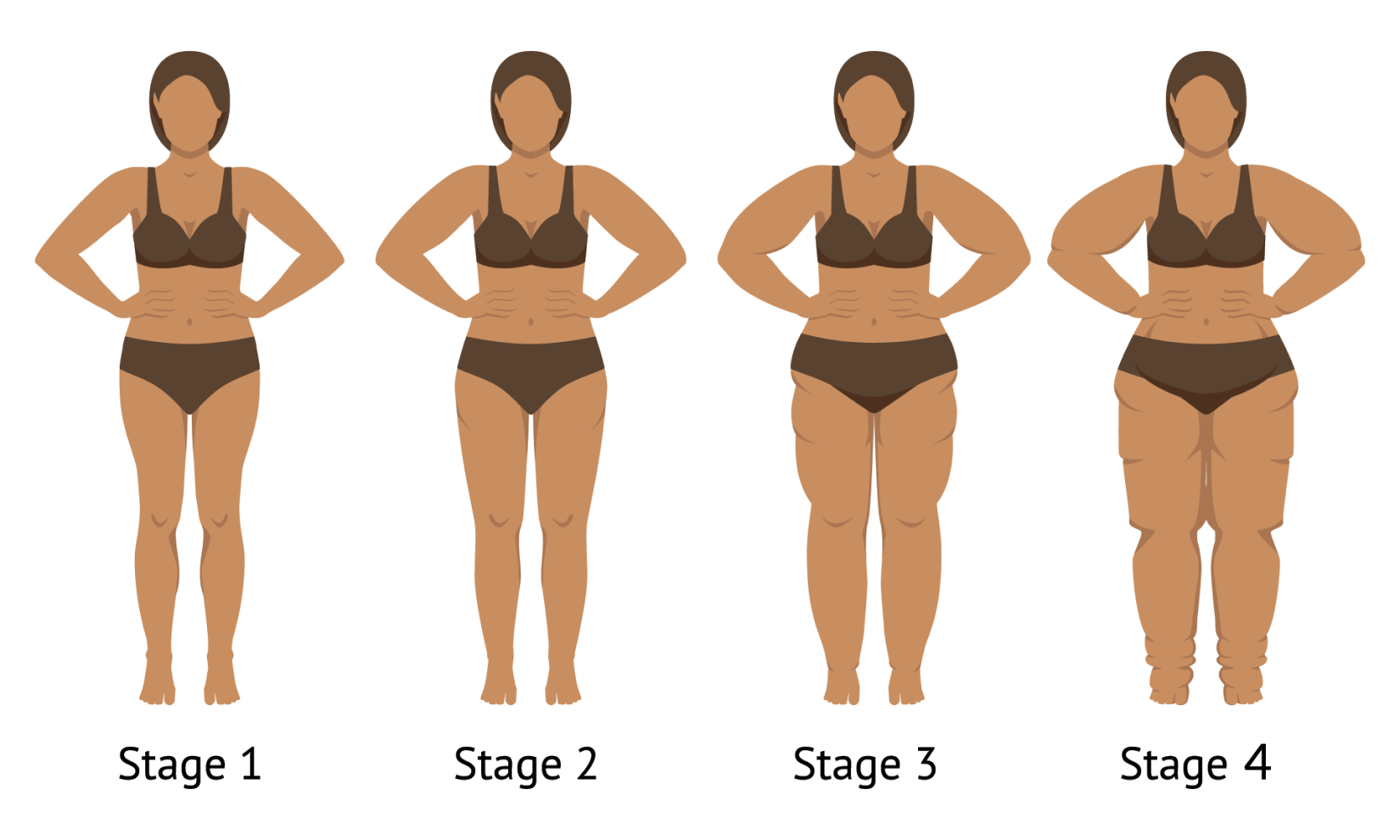 lipedema stages 1 4