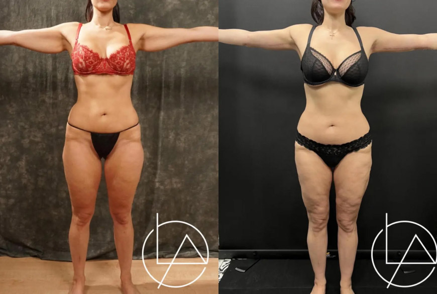 lipedema surgery before and after cNRVF6VEf8EQ highres