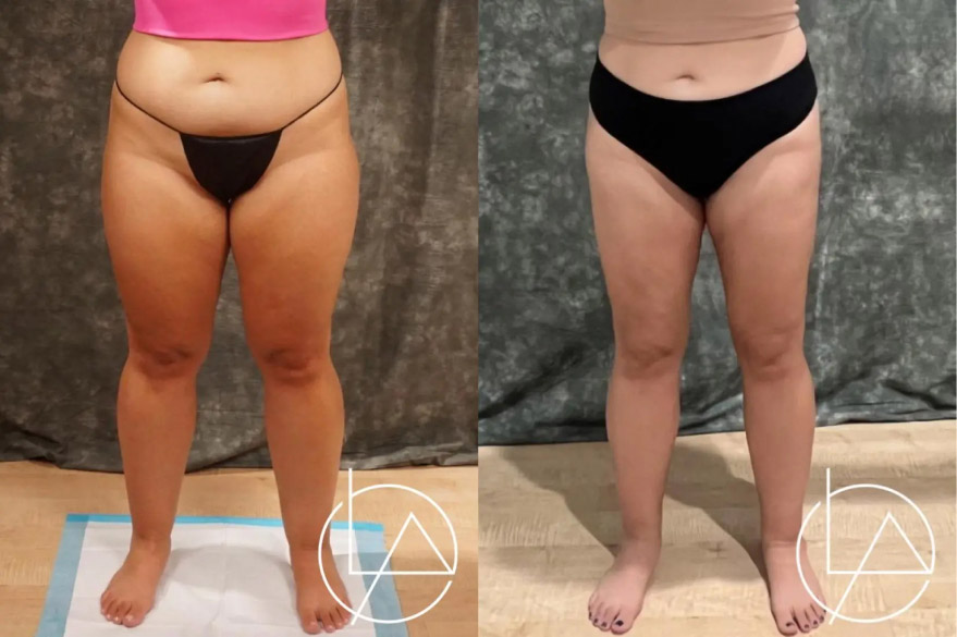 lipedema surgery before and after hIsBT0H0B9JQ highres