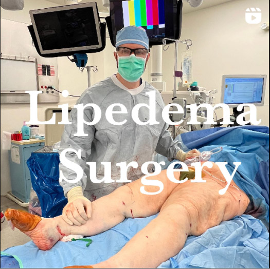 lipedema surgery