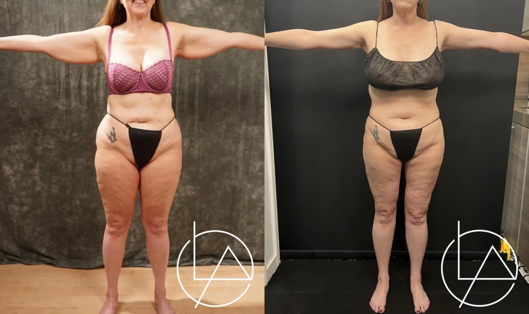 lipedema surgery before and after 4zpbBgH6Uiip highres